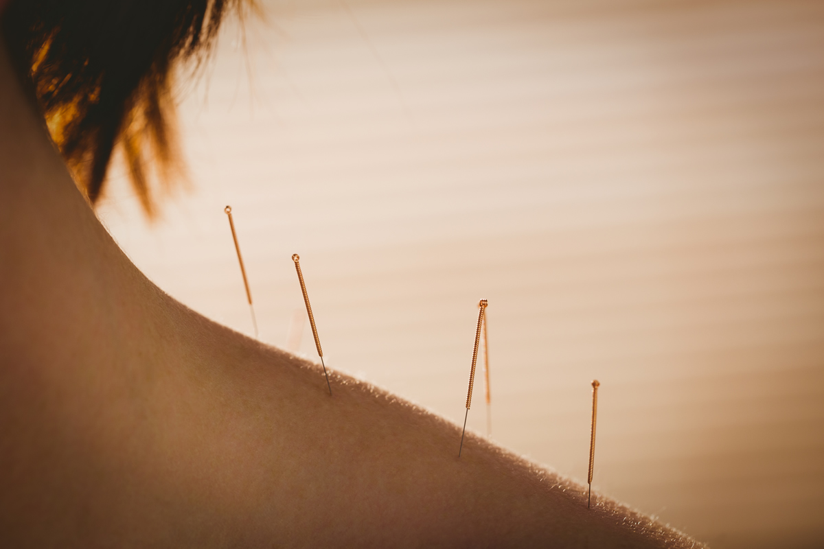Acupuncture at Allen Chiropractic Wellness Center