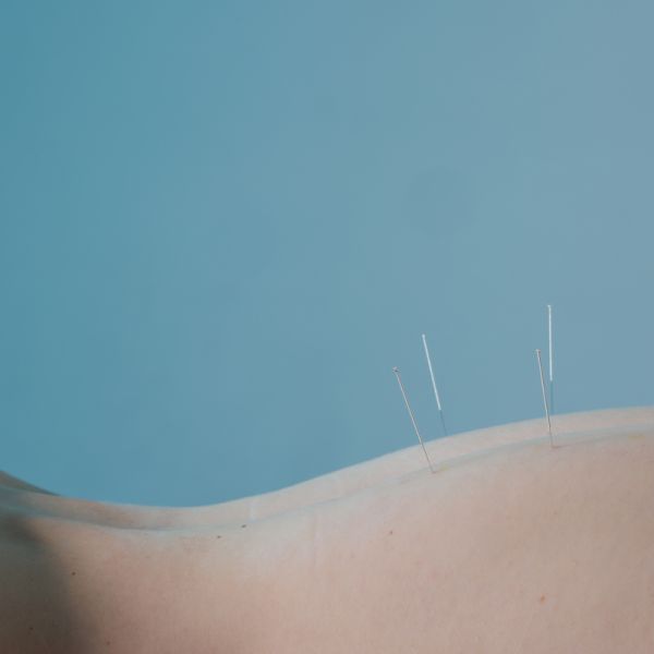 Acupuncture