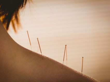 Acupuncture